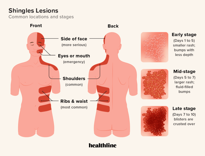 Shingles first sign of hiv