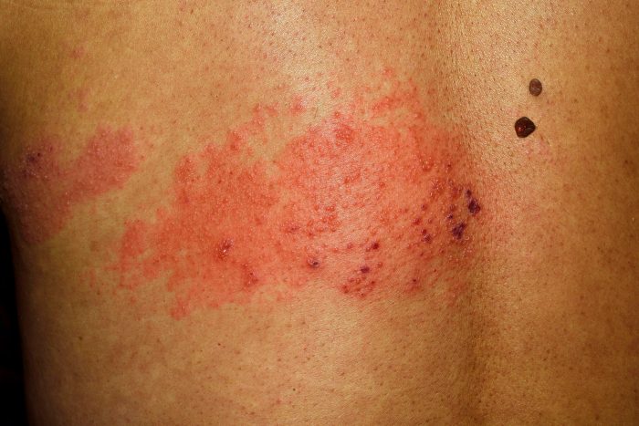 Shingles First Sign of HIV A Guide