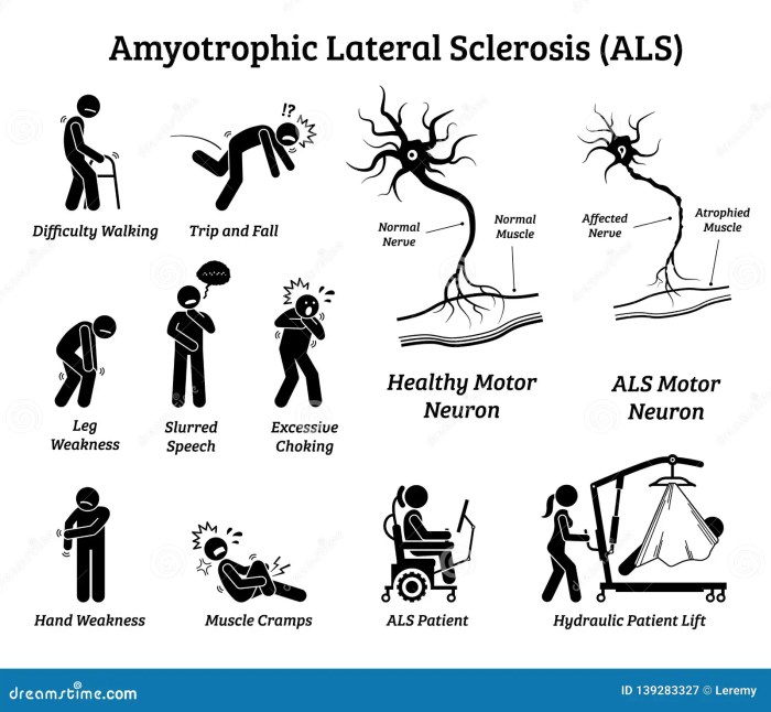 Als lou gehrigs disease life expectancy