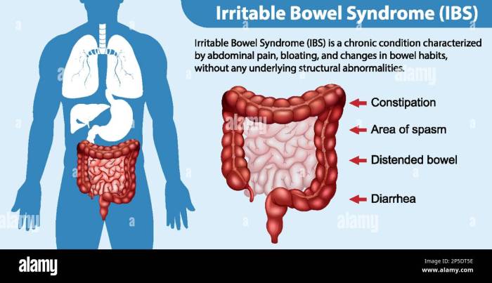 Irritable Bowel Syndrome Diet Plan to manage your IBS symptoms : r ... Ibs and diverticulosis what to do when you have both