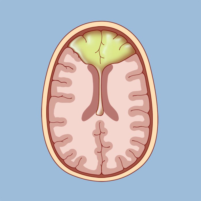 Oligodendroglioma overview and more