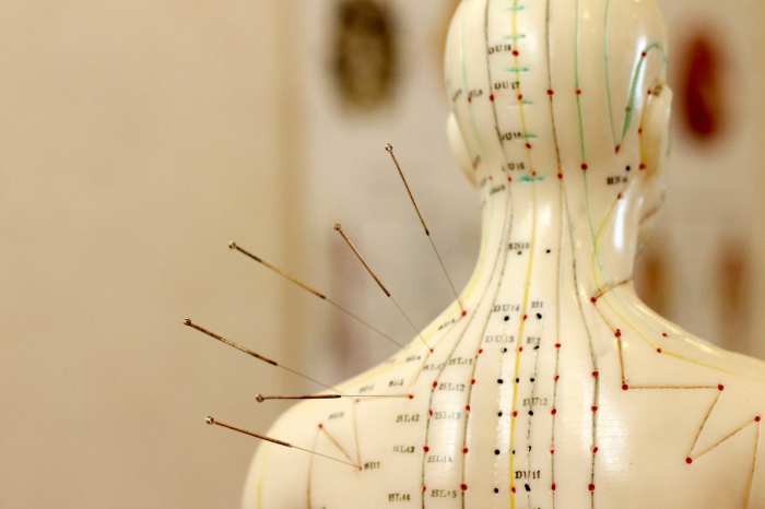 Acupuncture for weight loss