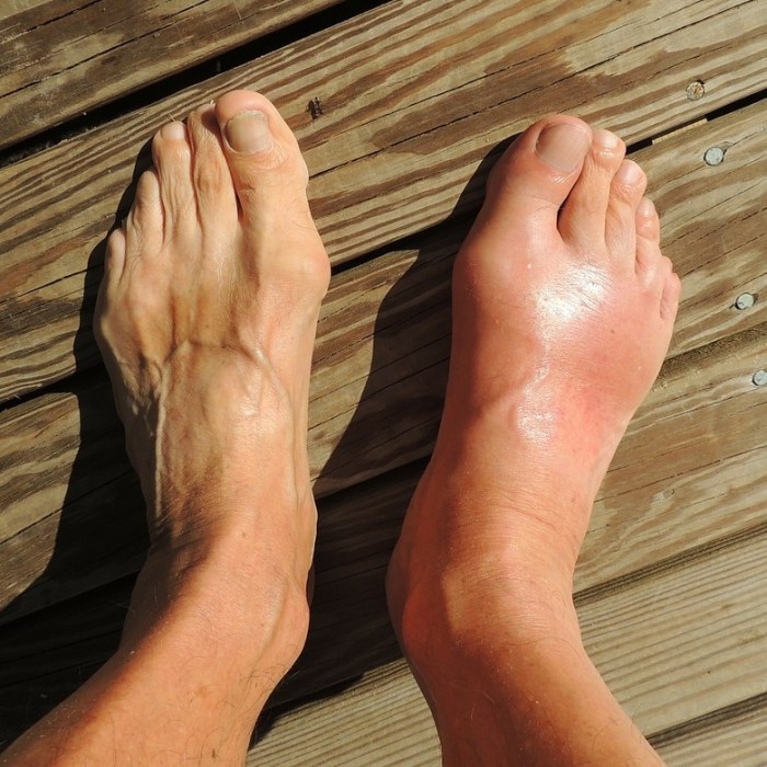 Is gout an autoimmune disease