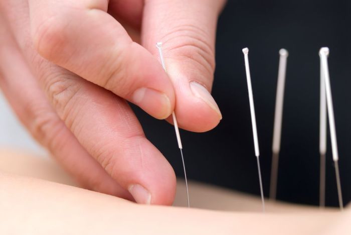 Acupuncture for weight loss