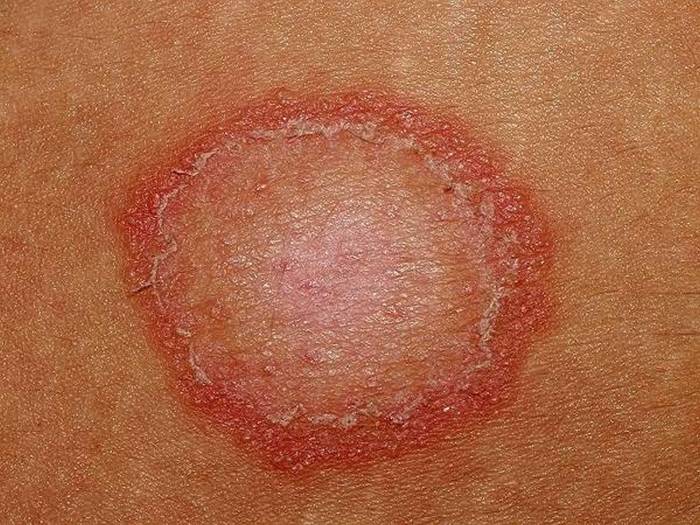 Ringworm signs symptoms complications