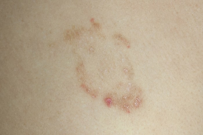Ringworm signs symptoms complications