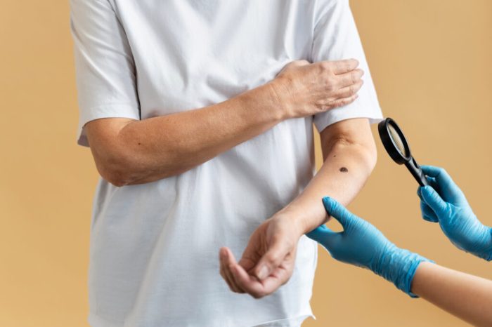 The abcds of melanoma