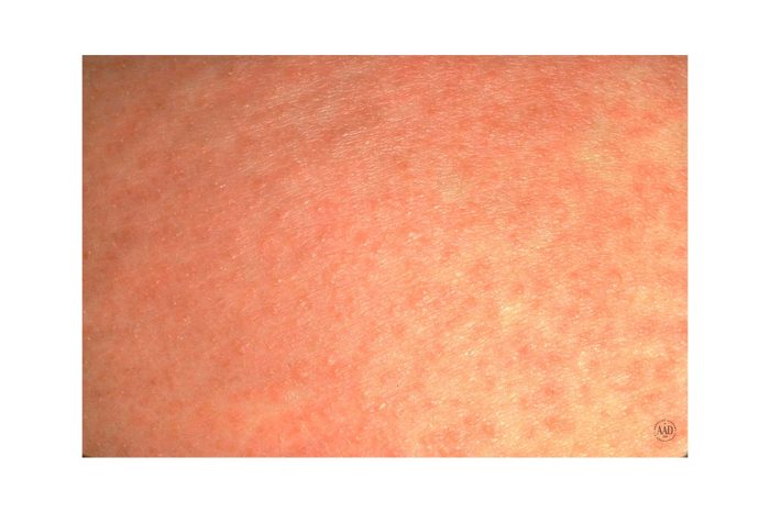 Two case reports of skin vasculitis following the COVID-19 immunization Rash kidney disease itchy skin