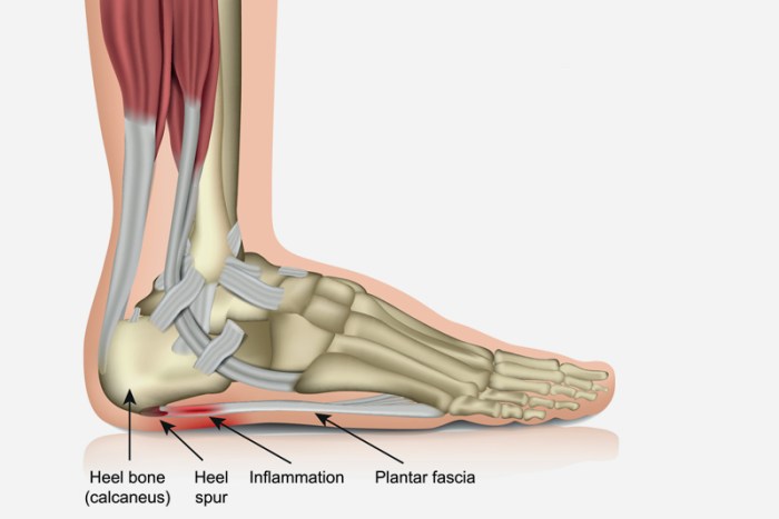 Heel Pain When Walking Understanding the Causes