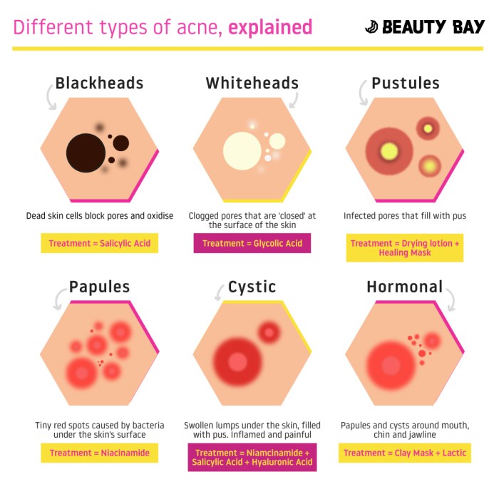 How to get rid of acne scars