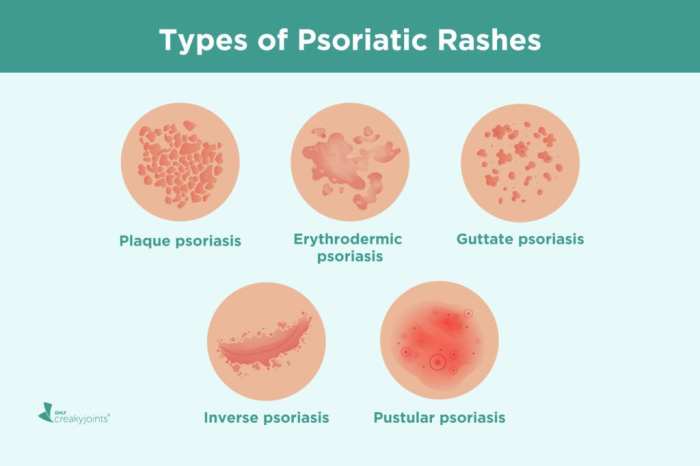 Psoriatic arthritis vs lupus