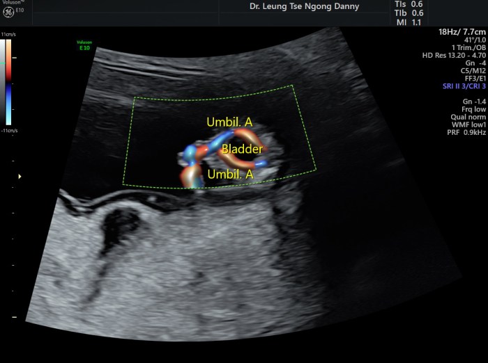 First Trimester Fetal Morphology Scan - HKOG-INFO What is an urachal remnant