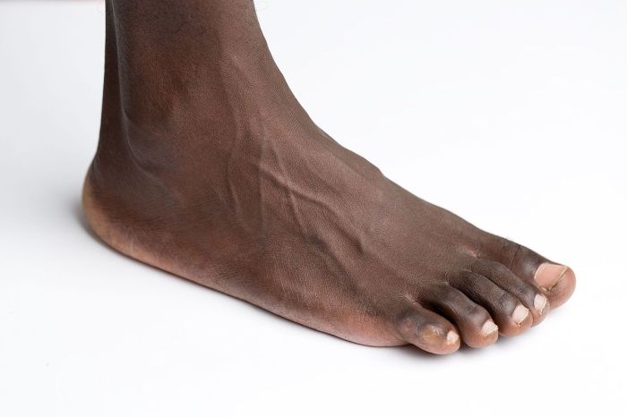 Exercise Program to Correct Foot Drop Your Guide