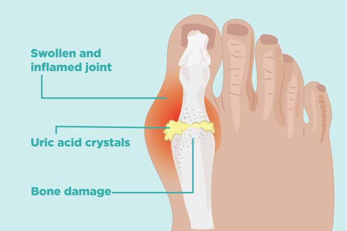 Gout tophi tophus what is it