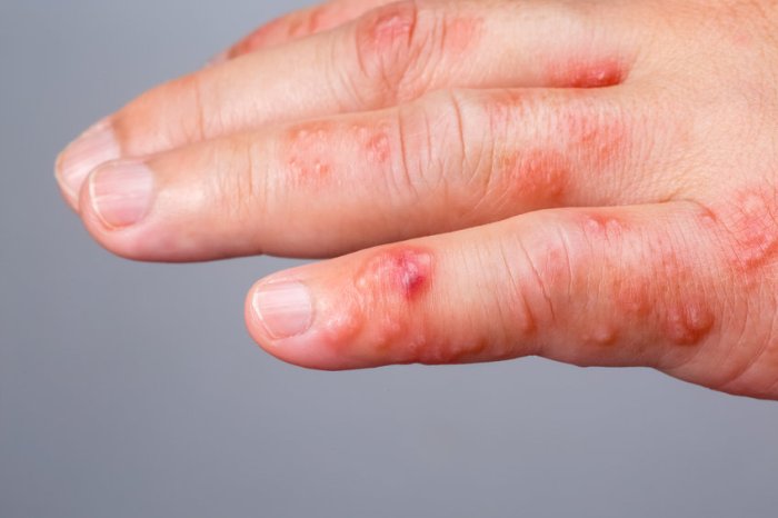 Symptoms of anemia in pregnancy