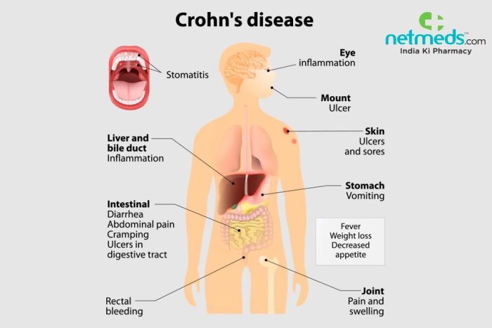 Crohn's Disease: Signs and Symptoms What are the symptoms of crohns disease