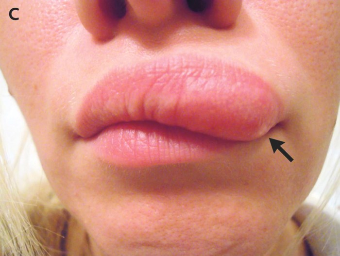 Is it a lump or a lymph node