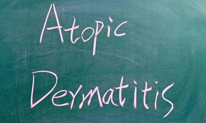 Immunotherapy for atopic dermatitis