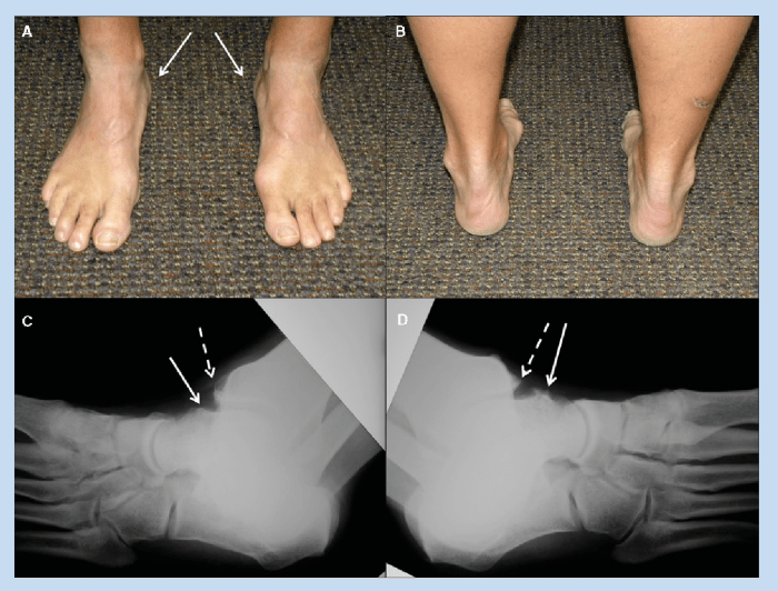 What are osteophytes bone spurs