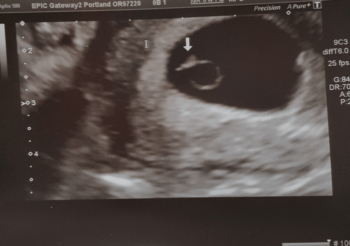 How Does A Miscarriage Look At 6 To 8 Weeks What does a miscarriage look like