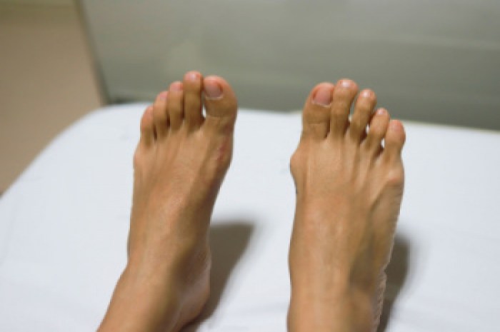 Early signs of bunions