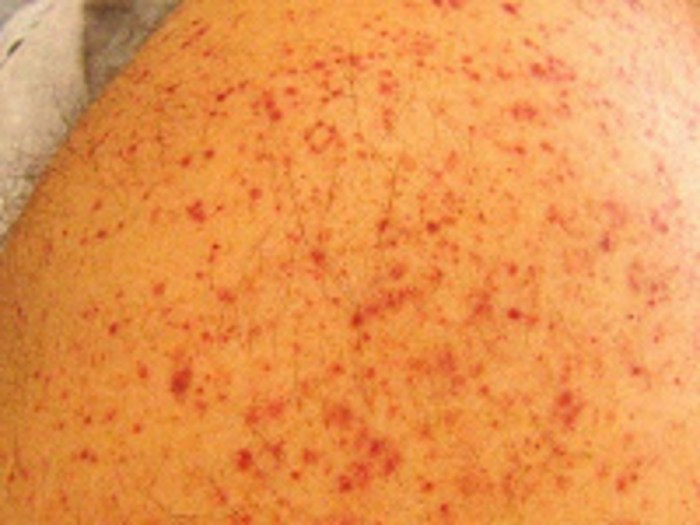 Lupus and Thrombocytopenia - Kaleidoscope Fighting Lupus Thrombocytopenia causes and risk factors
