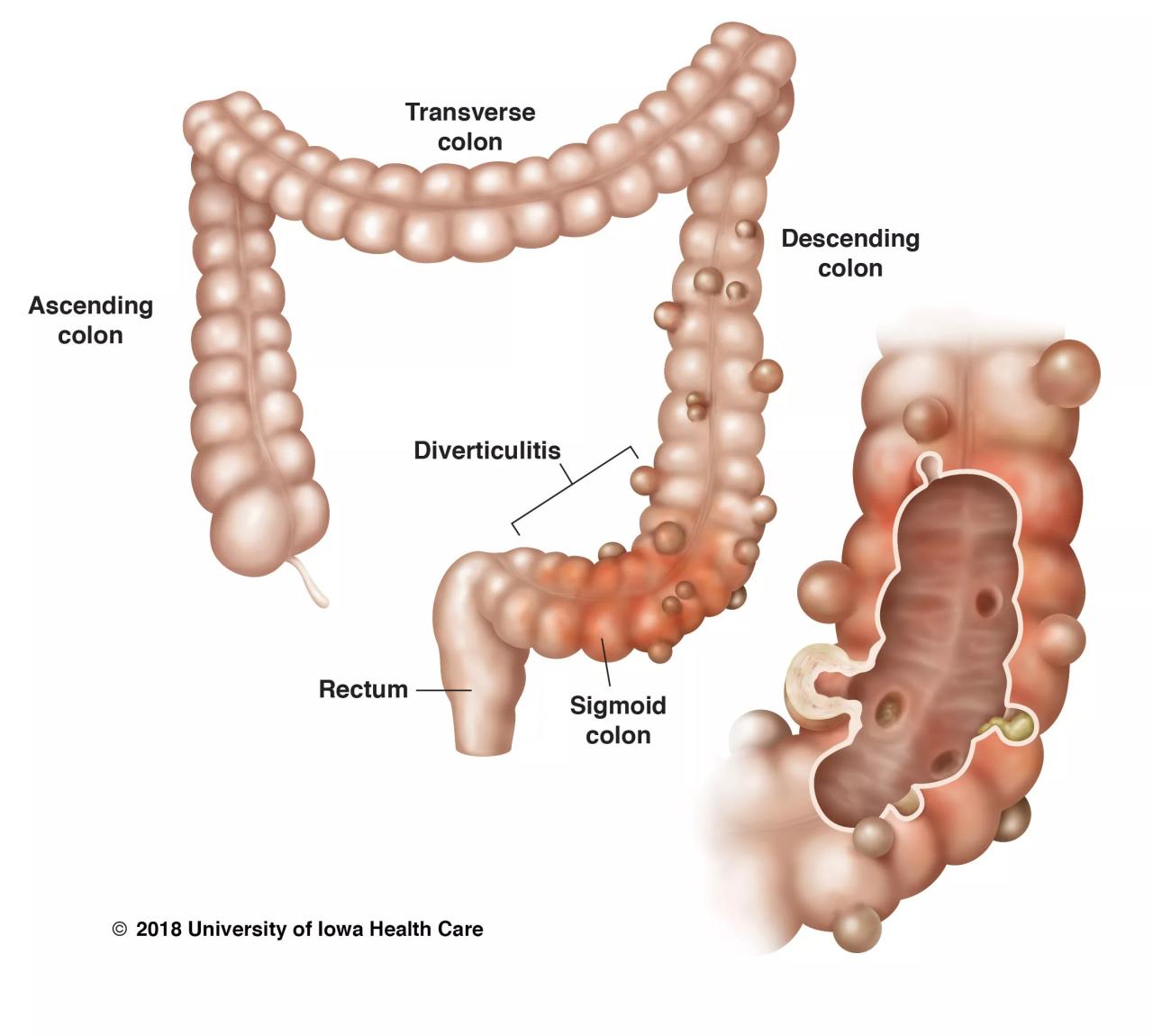 Diverticulitis vs Ulcerative Colitis A Deep Dive