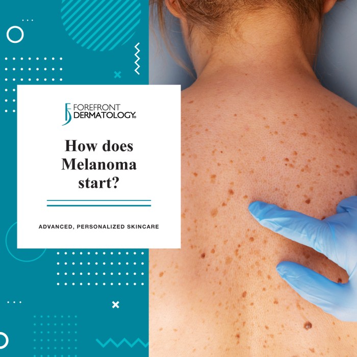 How Does Melanoma Start? - Forefront Dermatology The abcds of melanoma