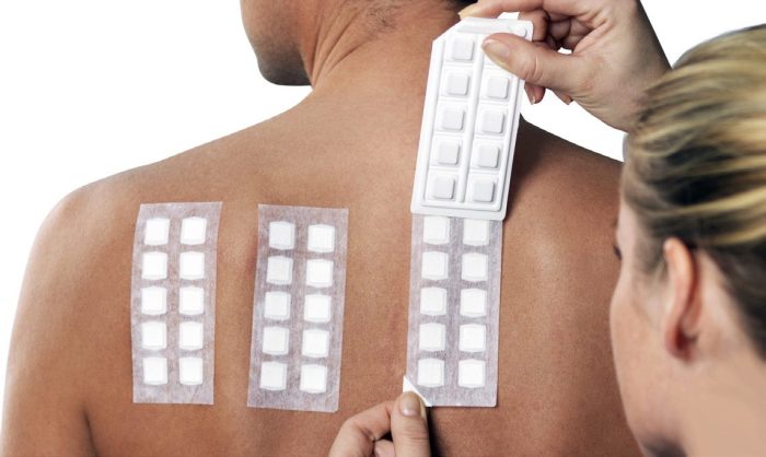 Patch testing for contact dermatitis