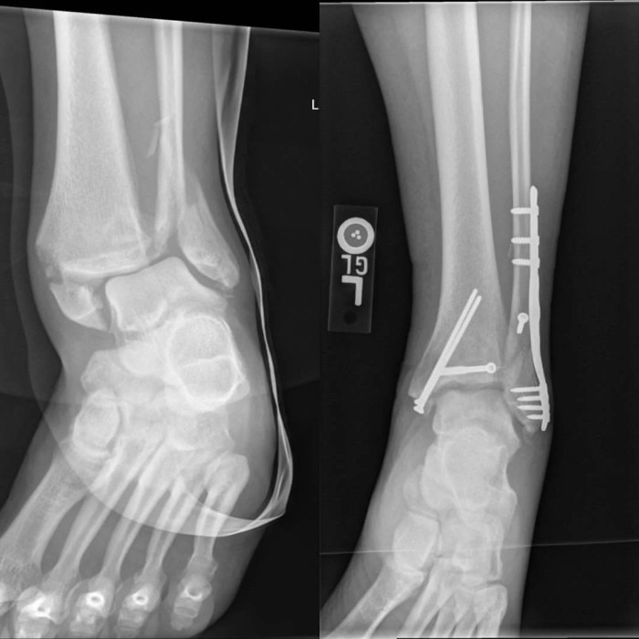 Sprained ankle vs broken ankle