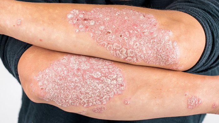 Manage and Understand Your Psoriasis — New River Dermatology Psoriatic disease drug pipeline