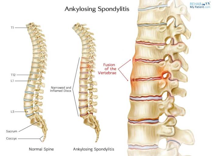 Treatment of ankylosing spondylitis