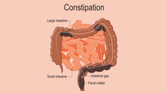 Constipation and Heart Problems A Deep Dive