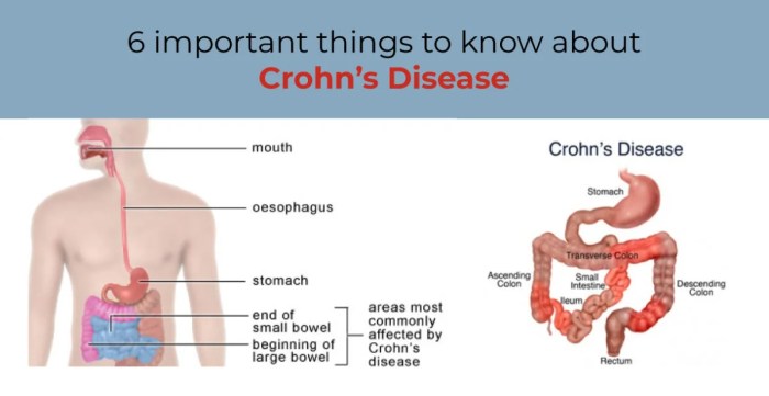 Crohn's Disease Symptoms, Causes, Complications Prevention, 50% OFF What are the symptoms of crohns disease