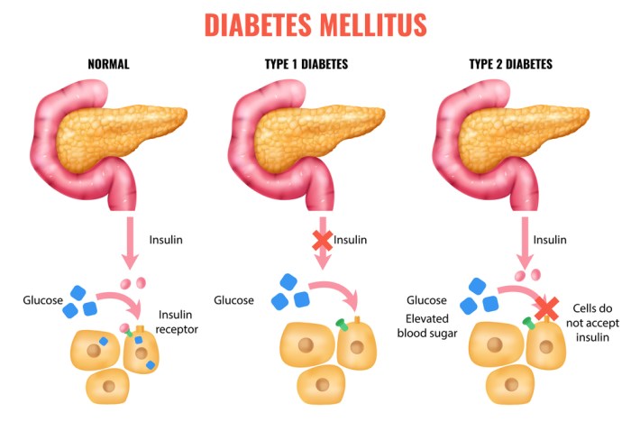 Diabetes and Shortness of Breath Understanding the Link