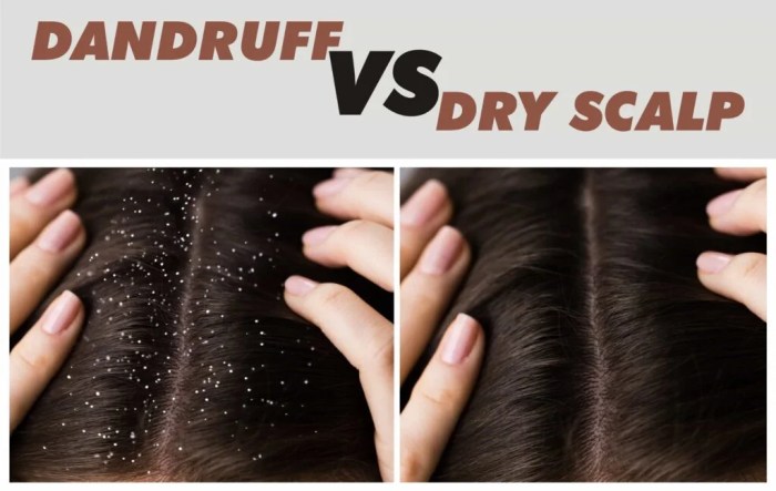 Dandruff Vs Dry Scalp Dandruff vs dry scalp
