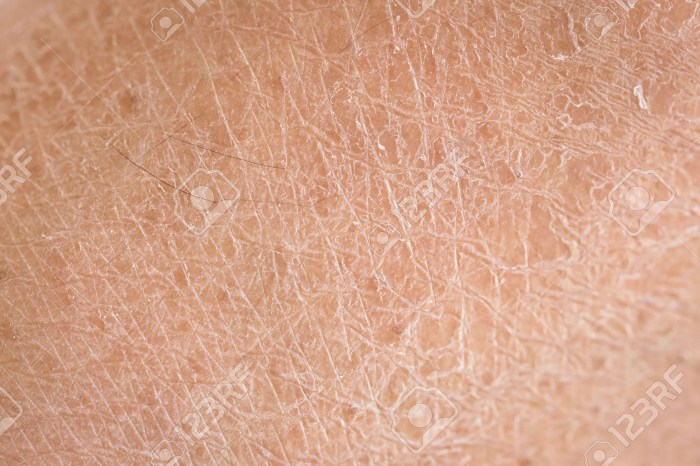 What is Tretinoin for Skin | Dr. Dennis Gross Retin a drying skin