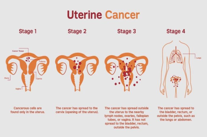 Endometrial Cancer Risk Factors A Comprehensive Guide