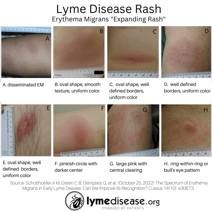 A Lyme rash doesn't always look like a bull's-eye target | LymeDisease.org Rash kidney disease itchy skin