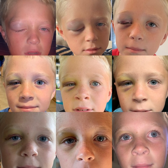 Burner stinger football injury