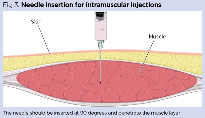 Intramuscular injections progesterone oil