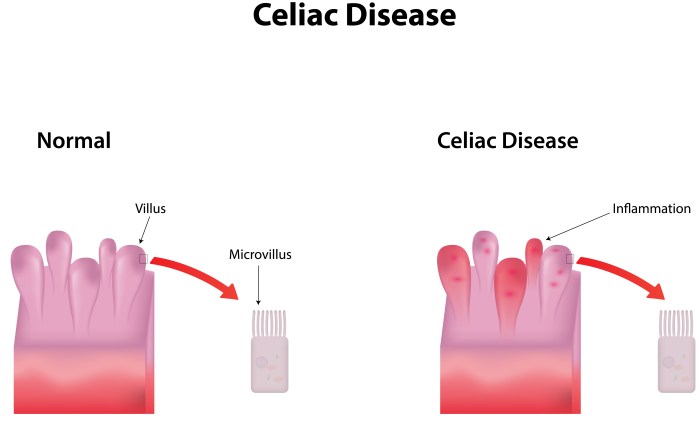 Marsh stage of celiac disease