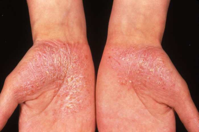 How psoriasis is diagnosed