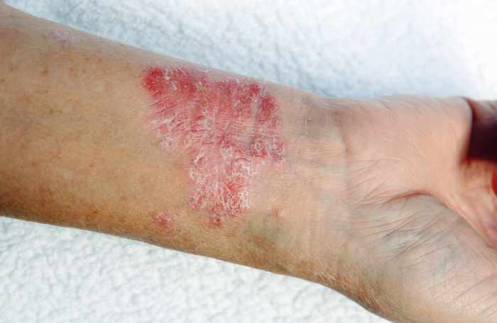 Recognizing and Managing Flares in Generalized Pustular Psoriasis Psoriatic disease drug pipeline