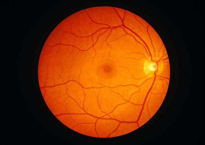 Fluid behind the retina