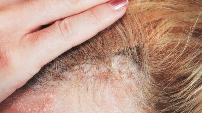Eczema on the Scalp A Comprehensive Guide