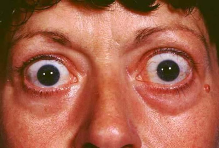 How Graves Disease Is Diagnosed A Comprehensive Guide