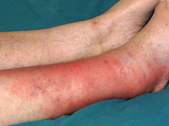 Cellulitis Healing Stages and Timeline A Comprehensive Guide