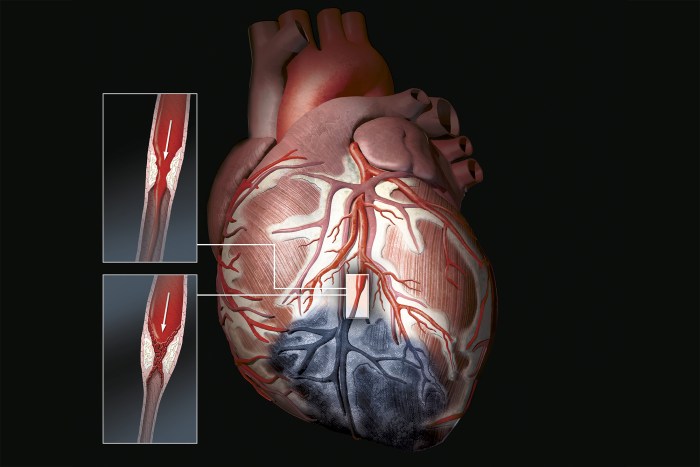 Chronic Limb Ischemia : Symptoms, Diagnosis, Treatment in Hyderabad What is ischemia p2