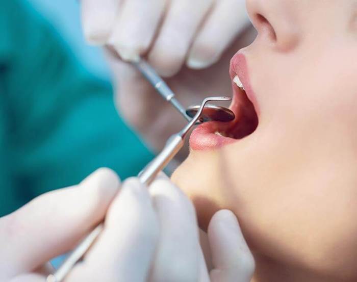 Wisdom Teeth Pain Relief A Comprehensive Guide
